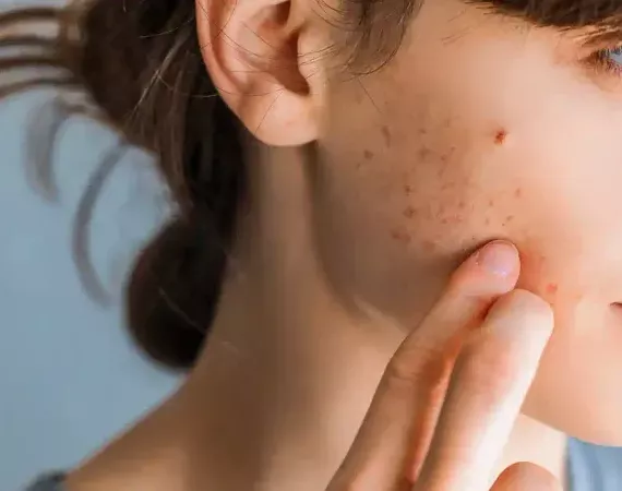 Eine junge Frau berührt ihre Wange, auf der größere Akne-Pickel sind.